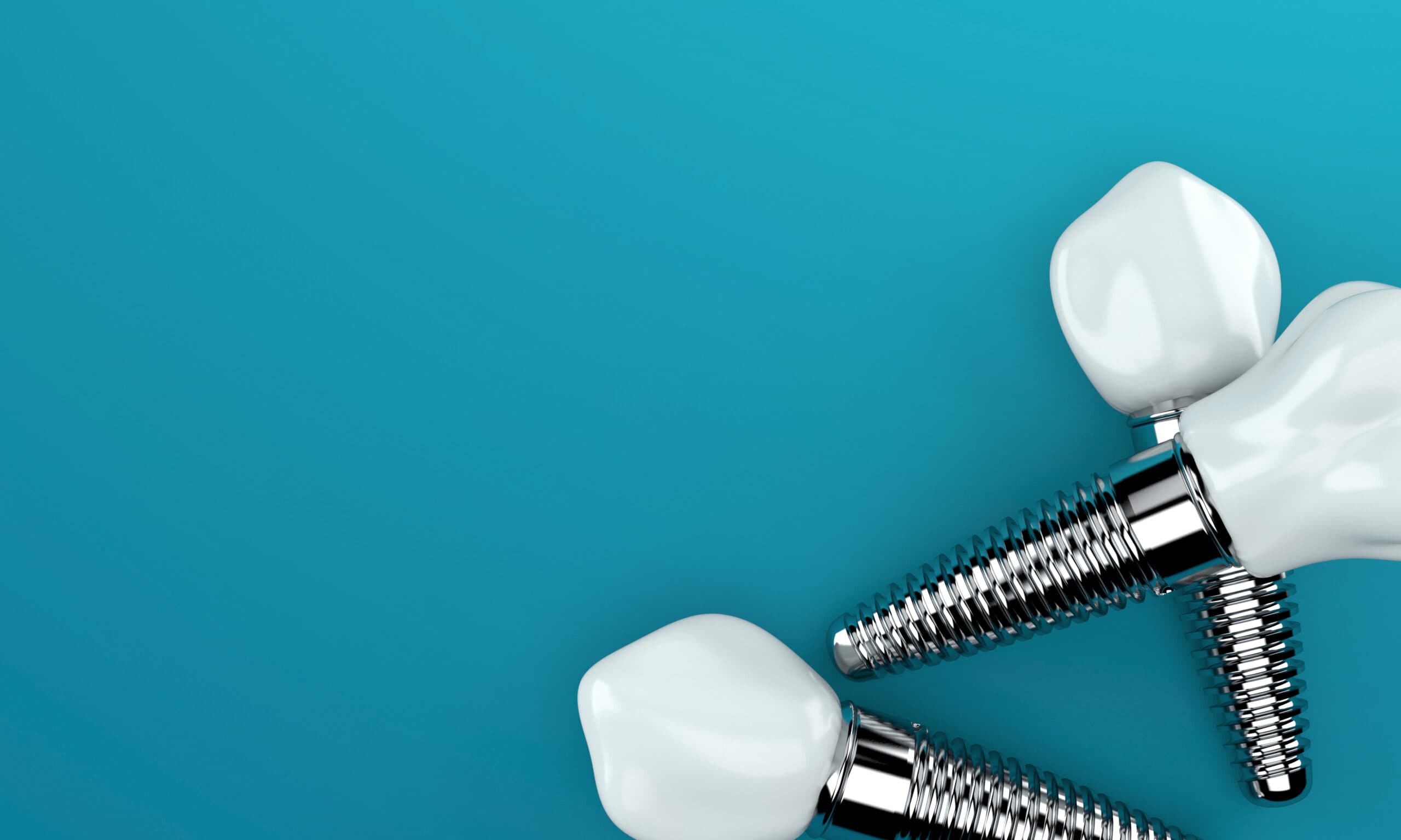 Illustration of dental implants with replacement tooth crowns